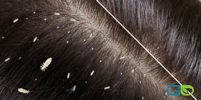 آیا درمان‌های خانگی بر روی شپش تاثیر دارند؟